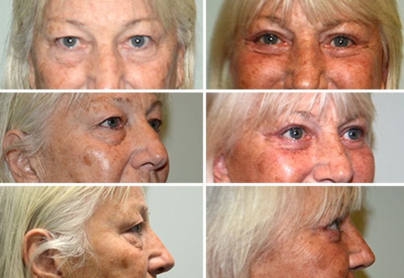Upper and Lower Blepharoplasty by Dr. Gardner