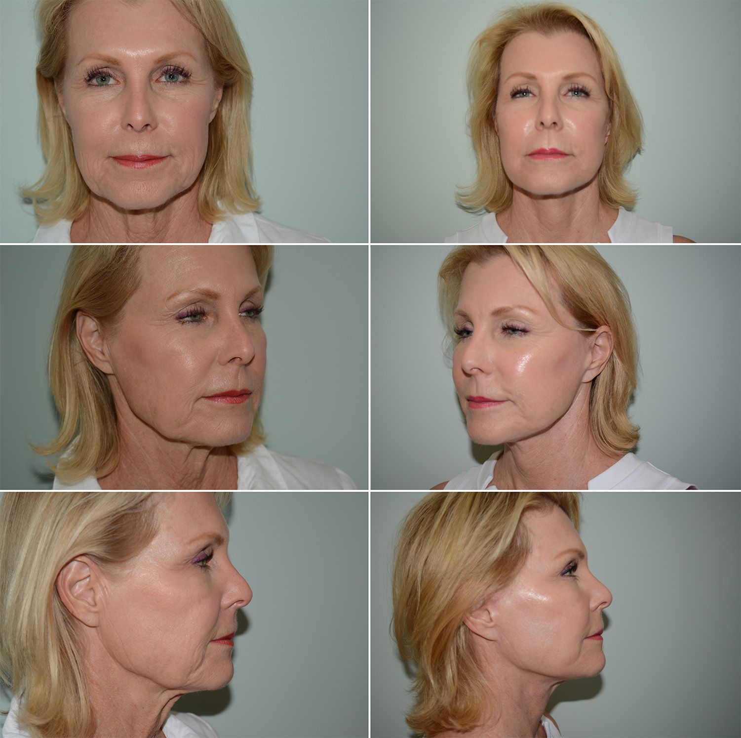 Brow Lift, Face Lift, and Neck Lift by Dr. Gardner