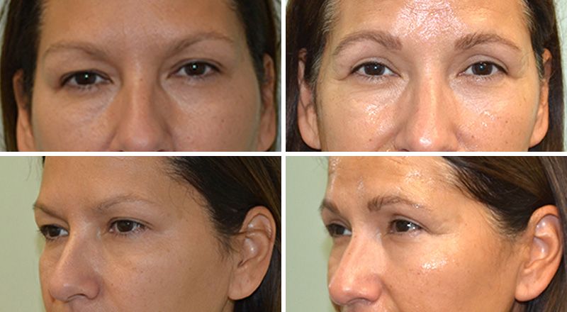 Blepharoplasty Performed by Dr. Baccaro