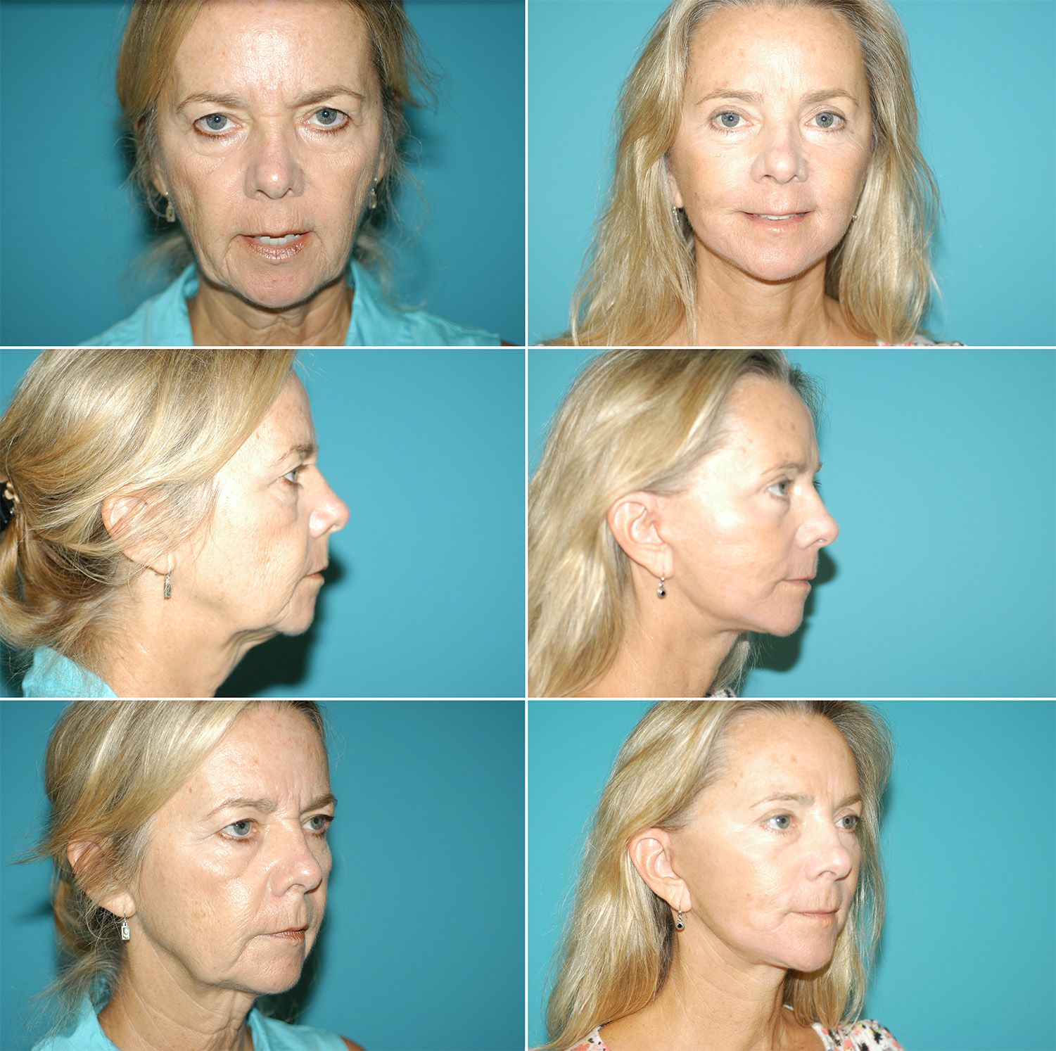 Upper Blepharoplasty, Brow Lift, Face Lift, Neck Lift with Fat Grafts