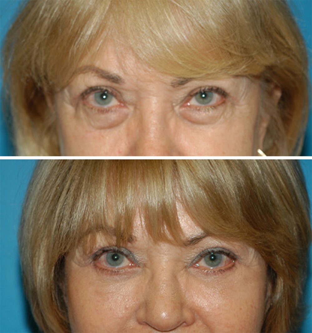 Lower Blepharoplasty by Dr. Gardner
