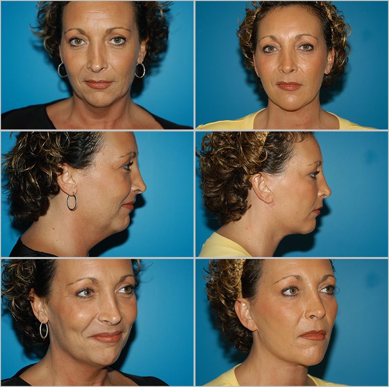 Neck Lift 01