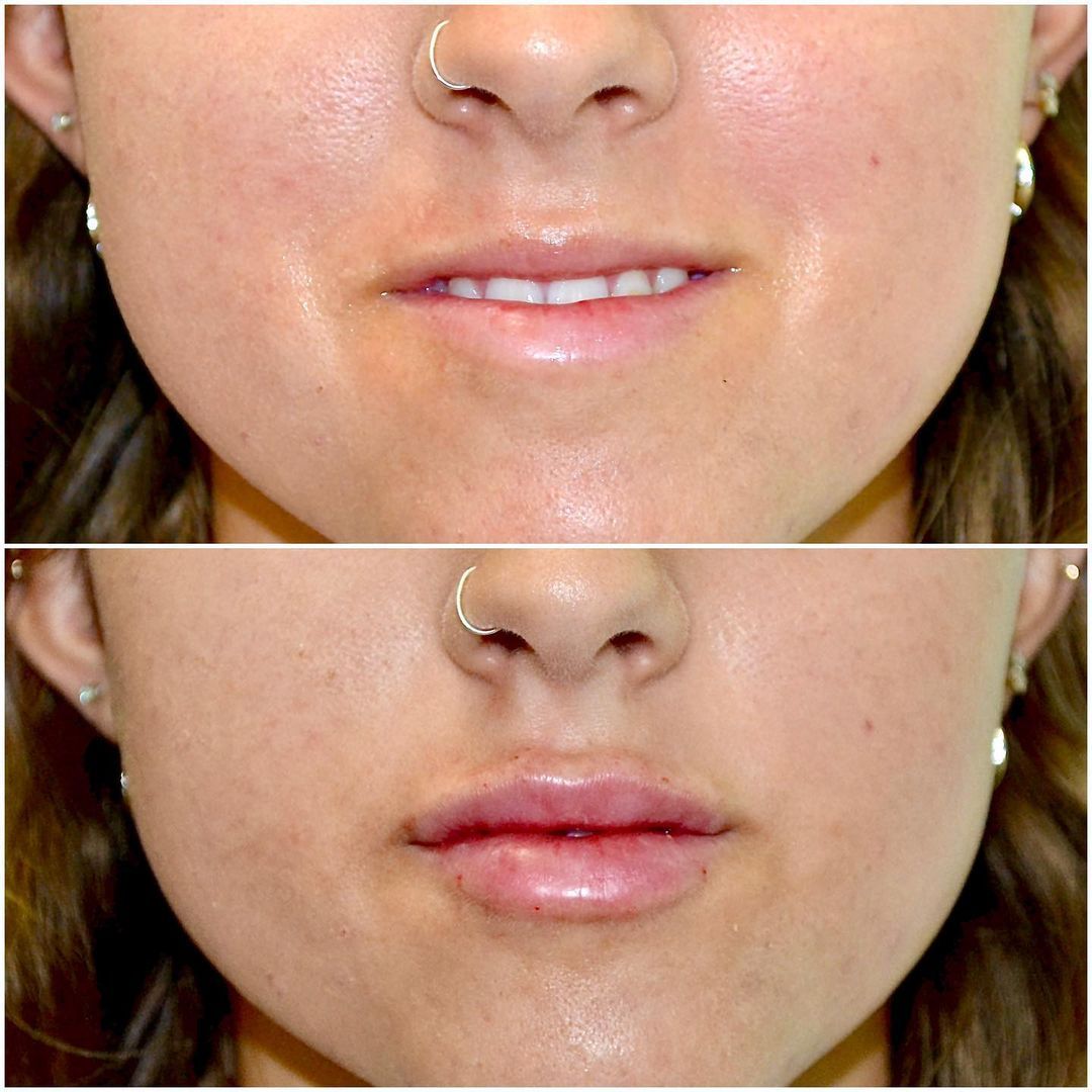 Lip Augmentation by Dr. Baccaro