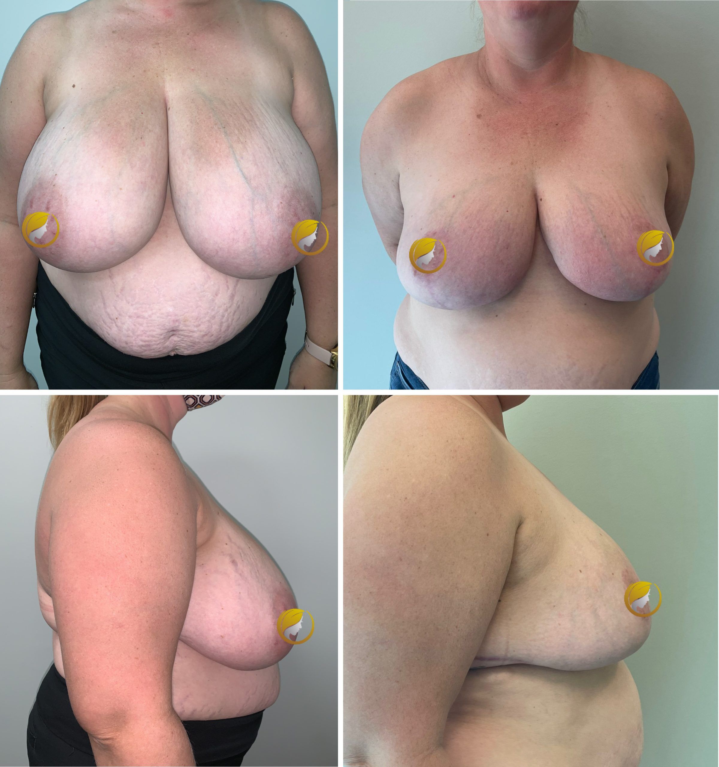 Breast Reduction Surgery by Dr. Bonett 