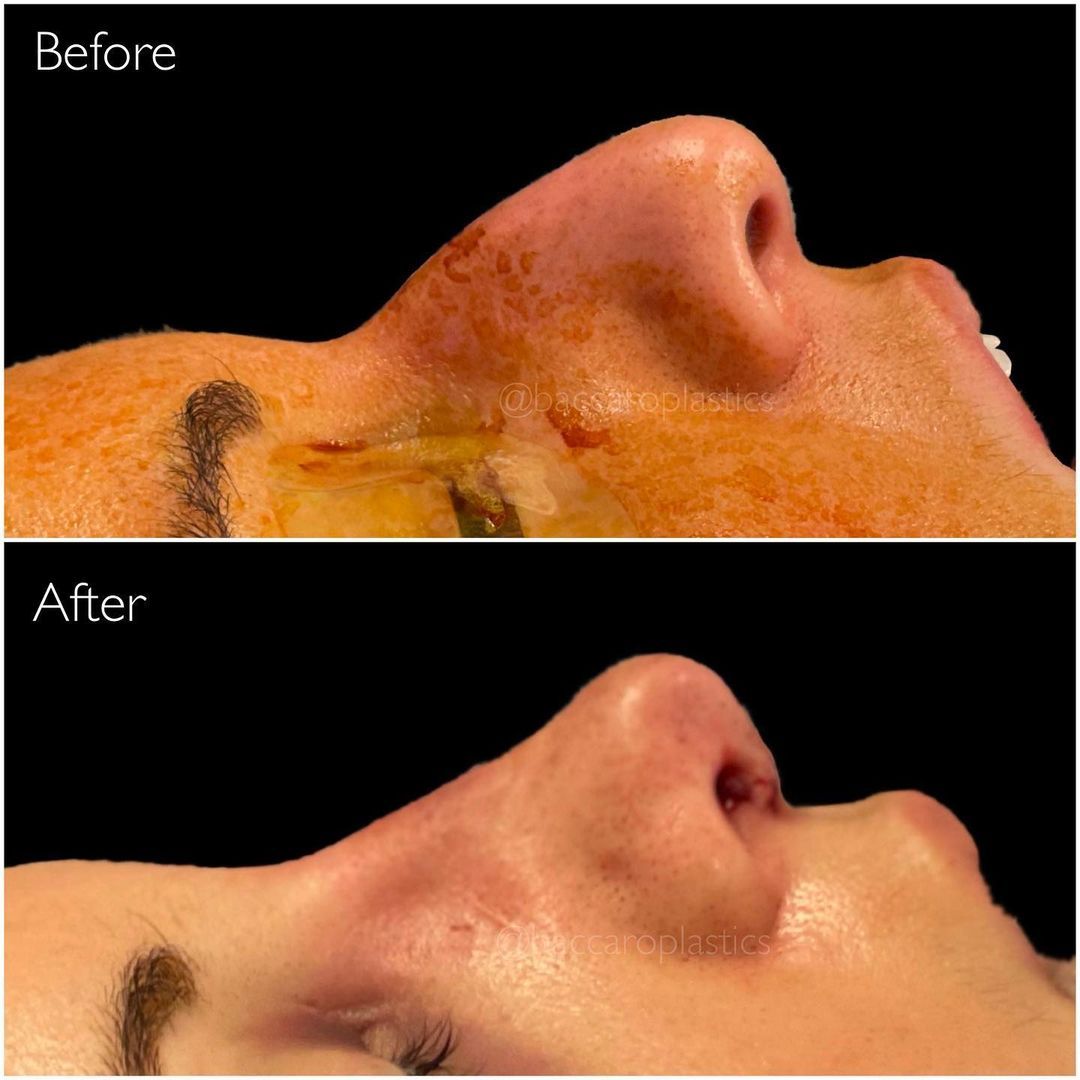 Rhinoplasty by Dr Bacarro