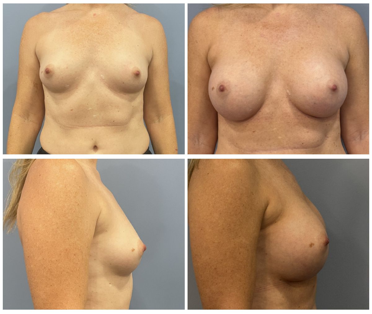 Walsh Breast Augmentation