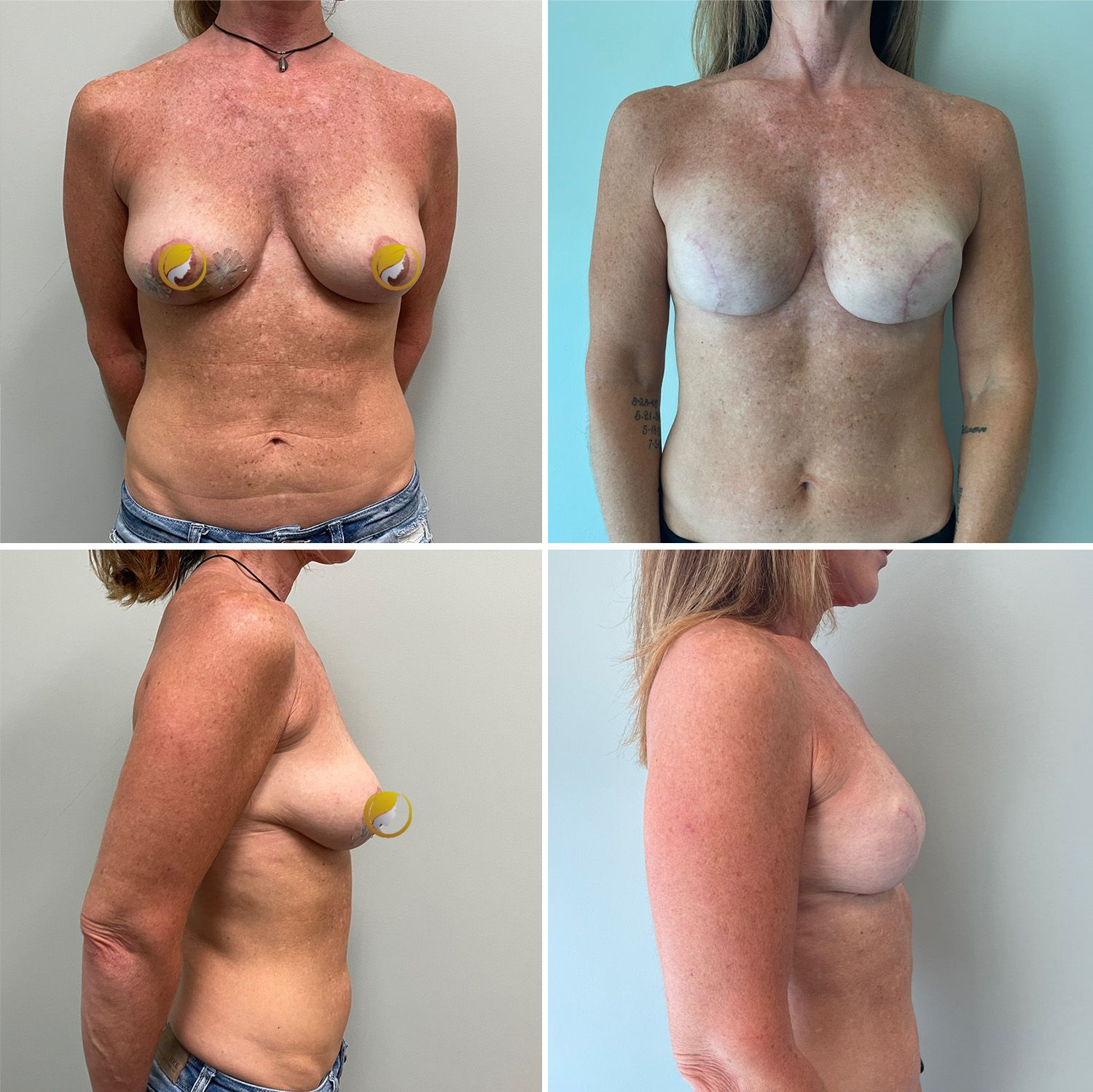 Breast Reconstruction Surgery by Dr. Bonett 