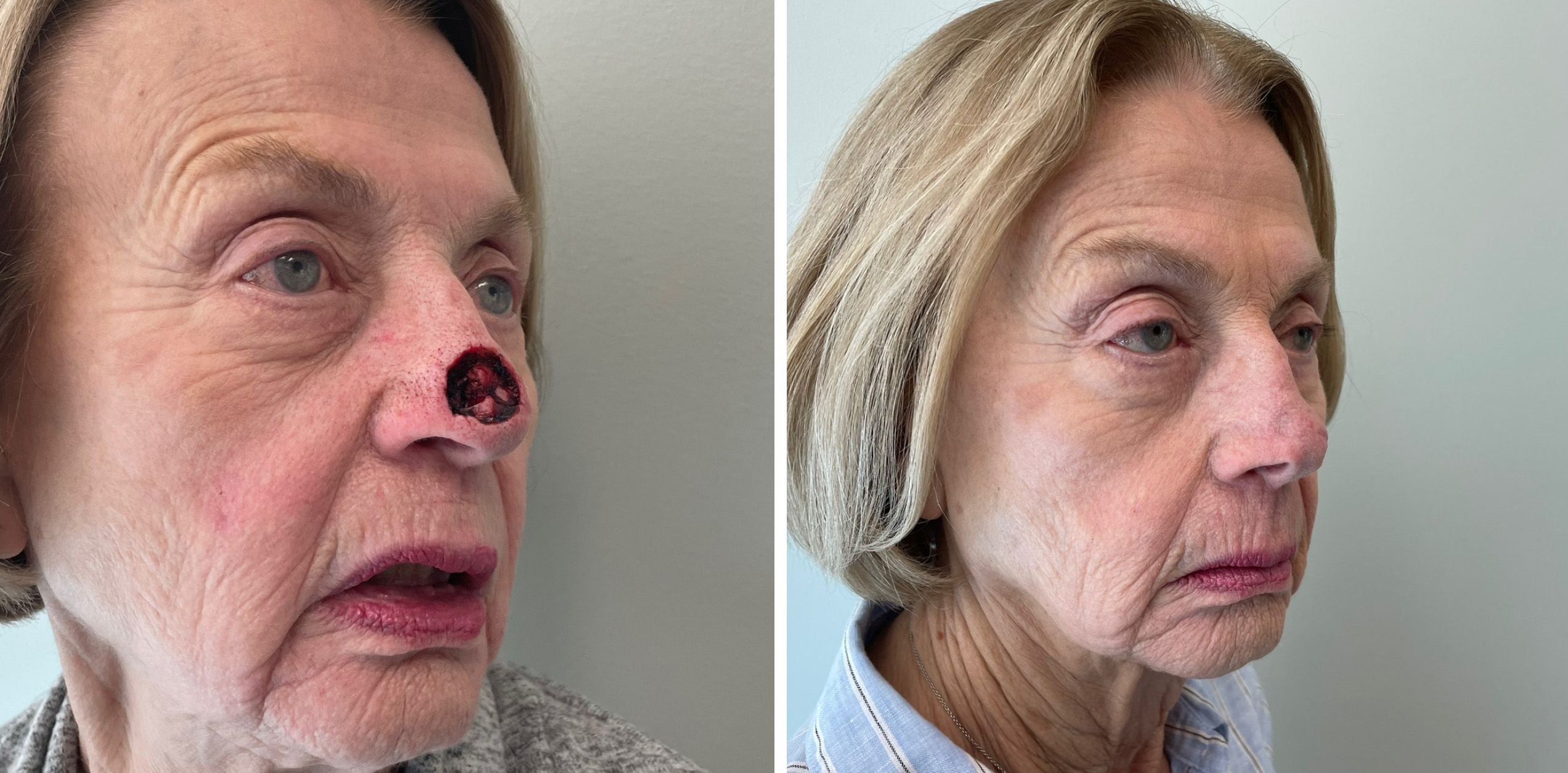 Mohs Reconstruction Surgery by Dr. Bonett 