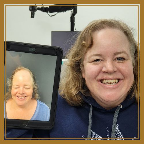 woman's hair loss transplant image naples florida