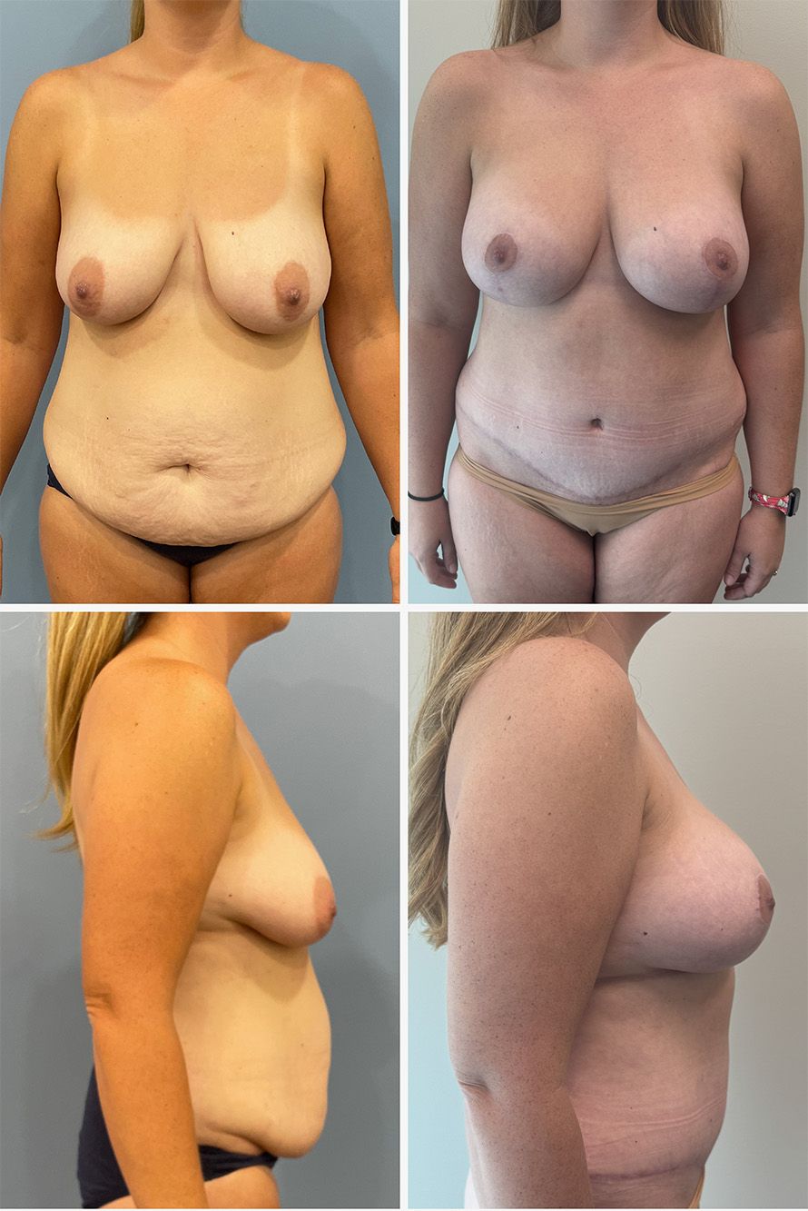 Mommy Makeover Performed by Dr. Walsh
