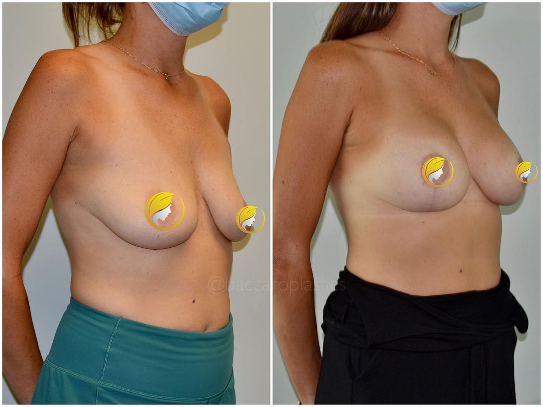 Breast Augmentation & Lift by Dr. Baccaro