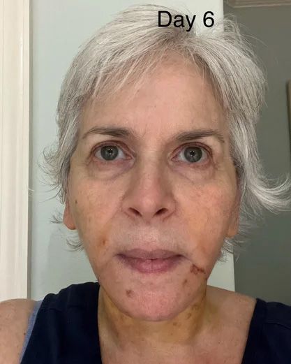 Neck Lift & Facial Fat Transfer Day 6