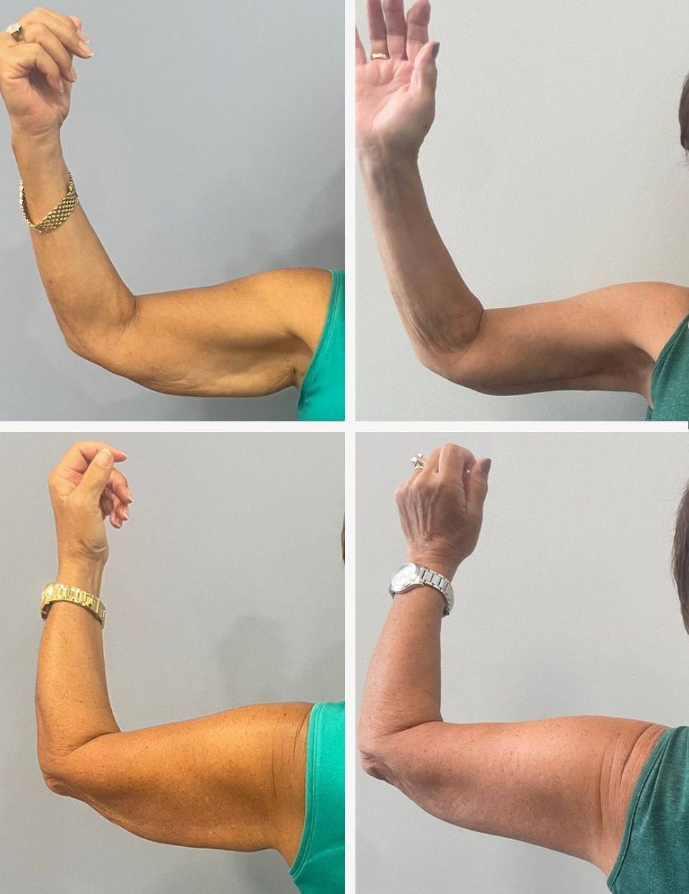 Arm Lift Performed by Dr. Walsh