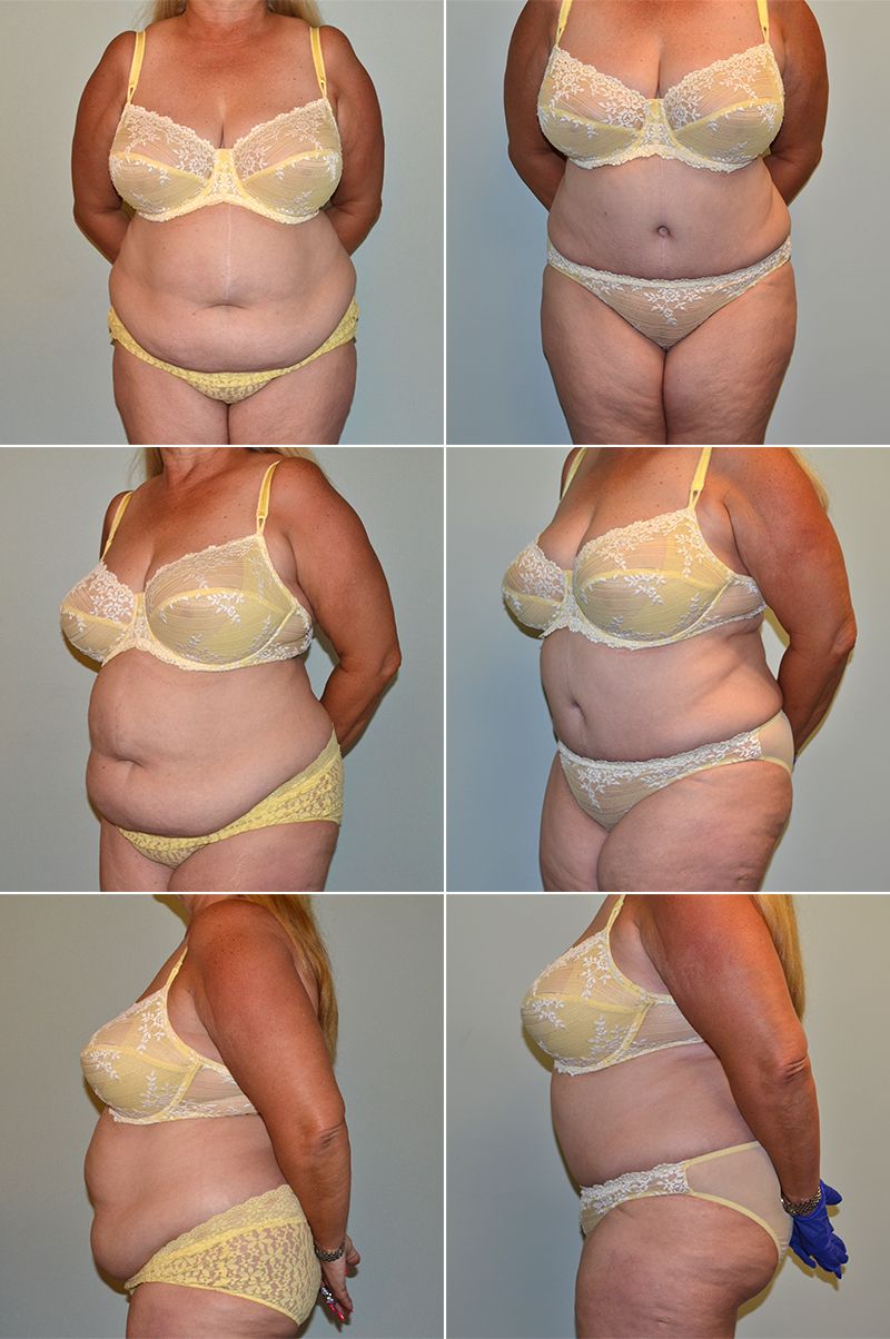 tummy tuck 12
