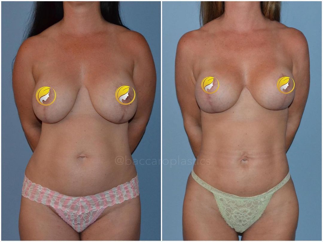 Lipo by Dr. Baccaro