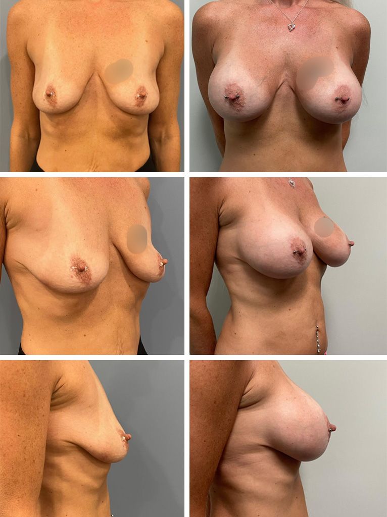 Breast Augmentation Performed by Dr. Bonett