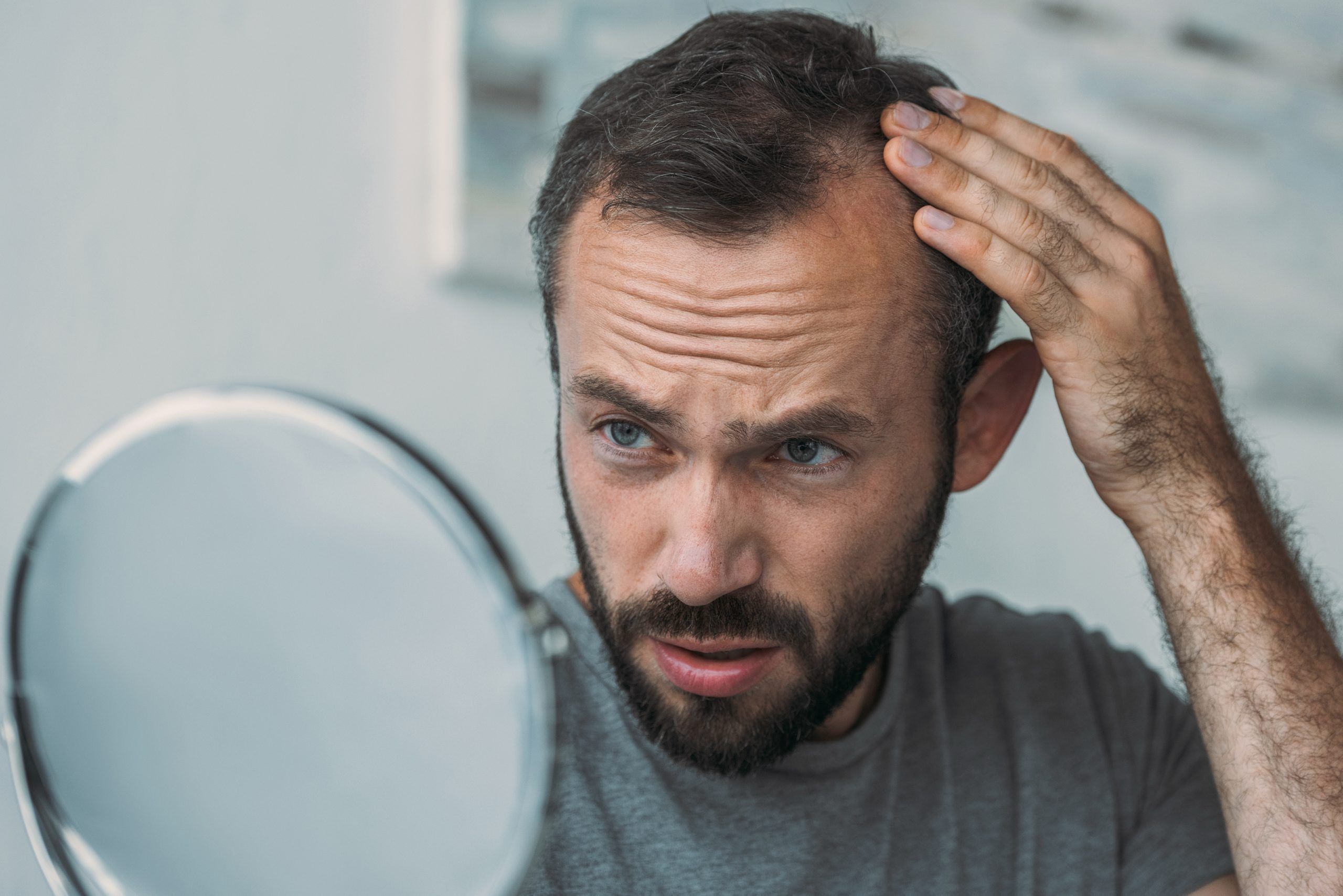 male hair loss image from naples hair restoration specialist