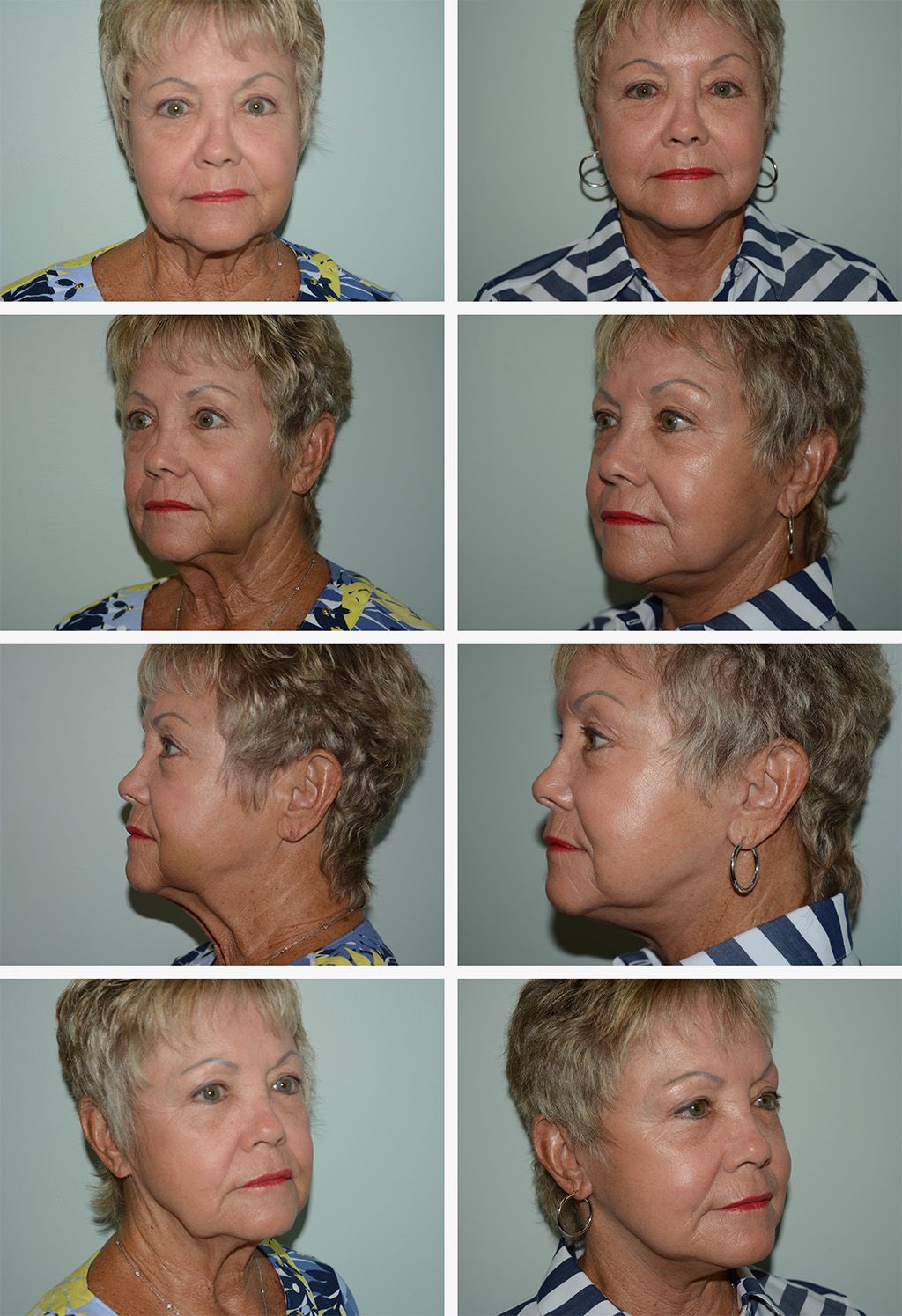 Mini Facelift Performed by Dr. Gardner
