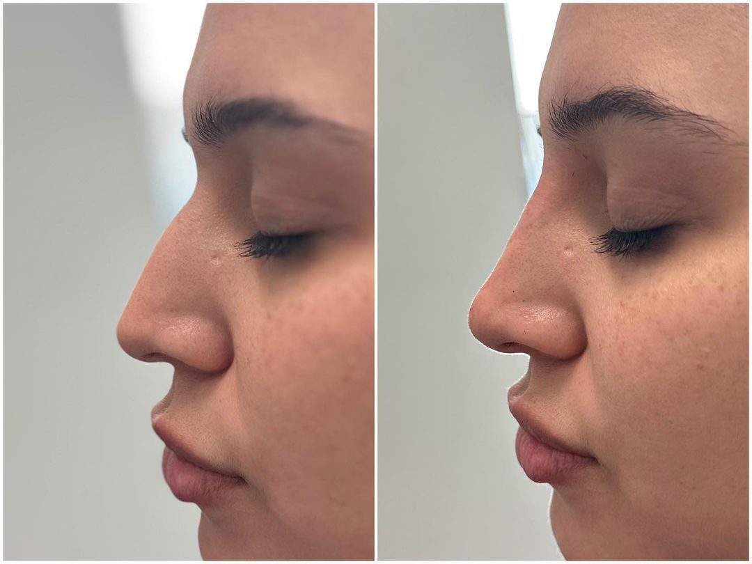 Rhinoplasty by Dr. Baccaro