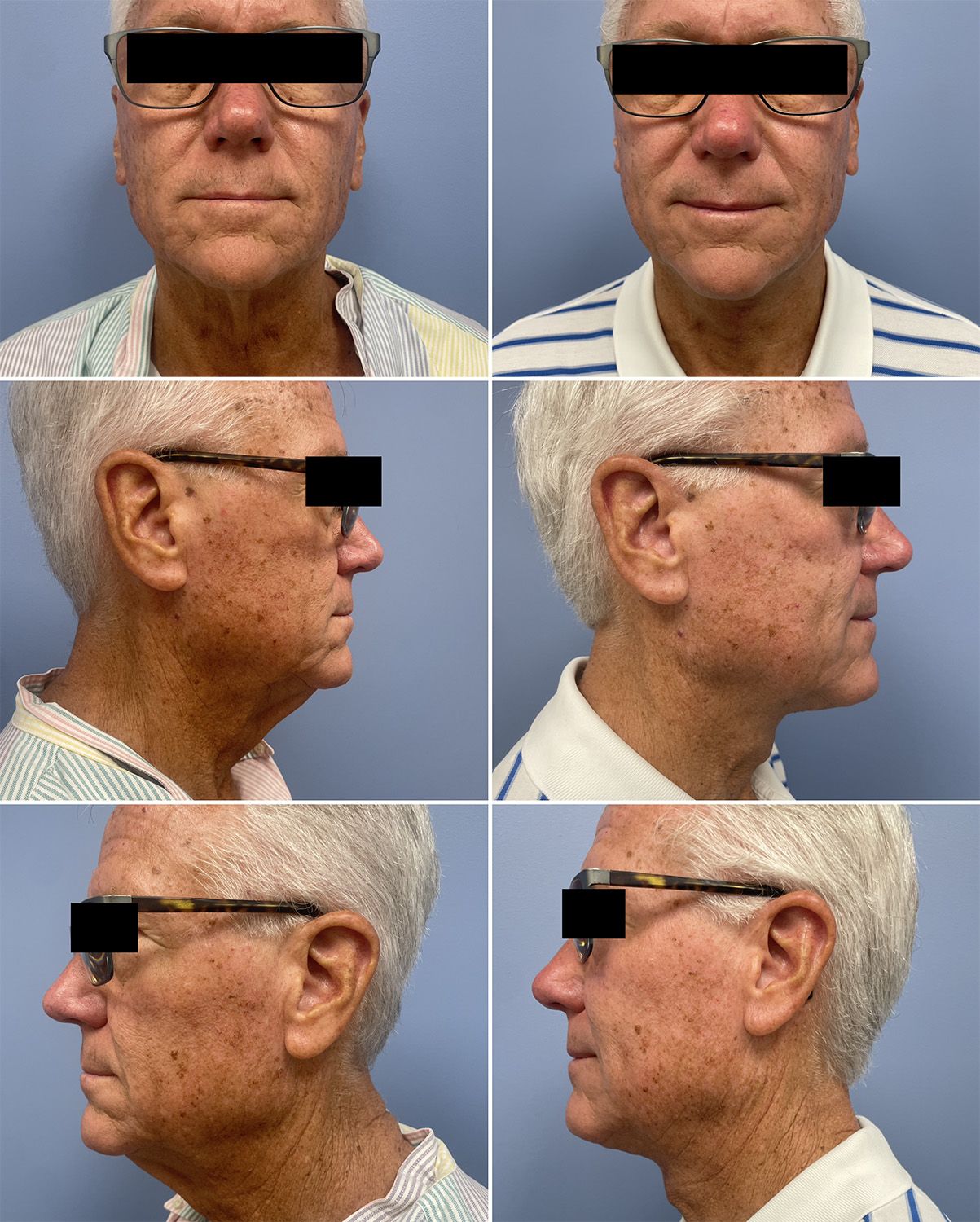 Anterior Cervicoplasty Performed by Dr Walsh