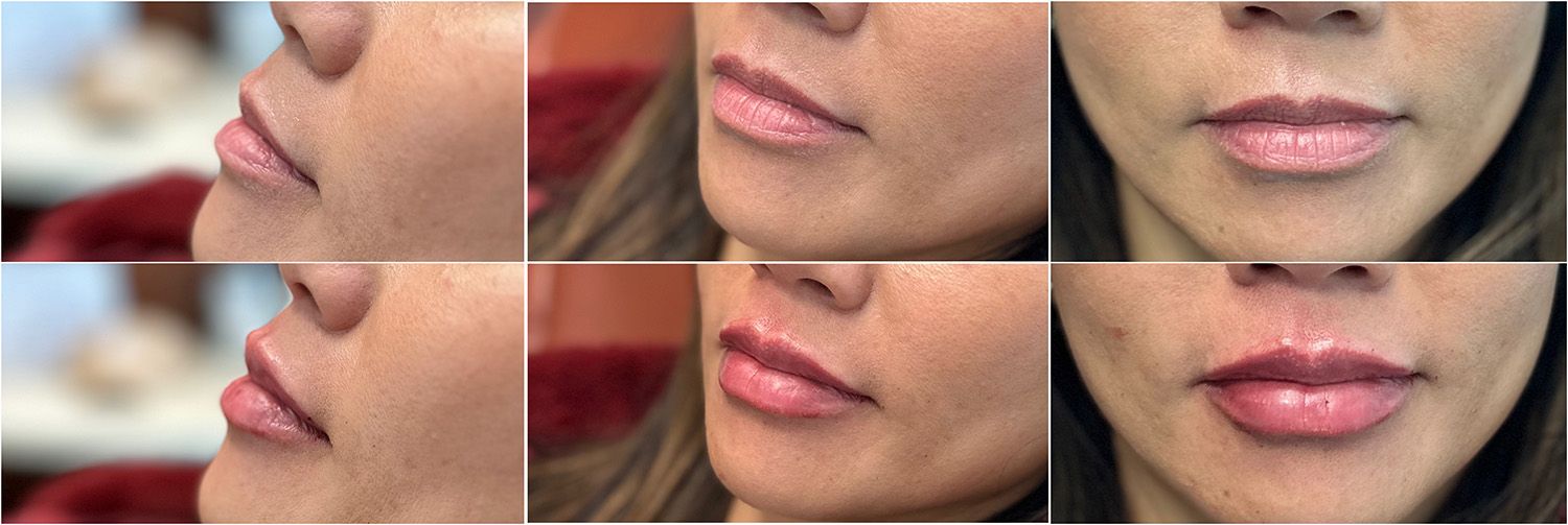 Lip Filler by Dr. Baccaro