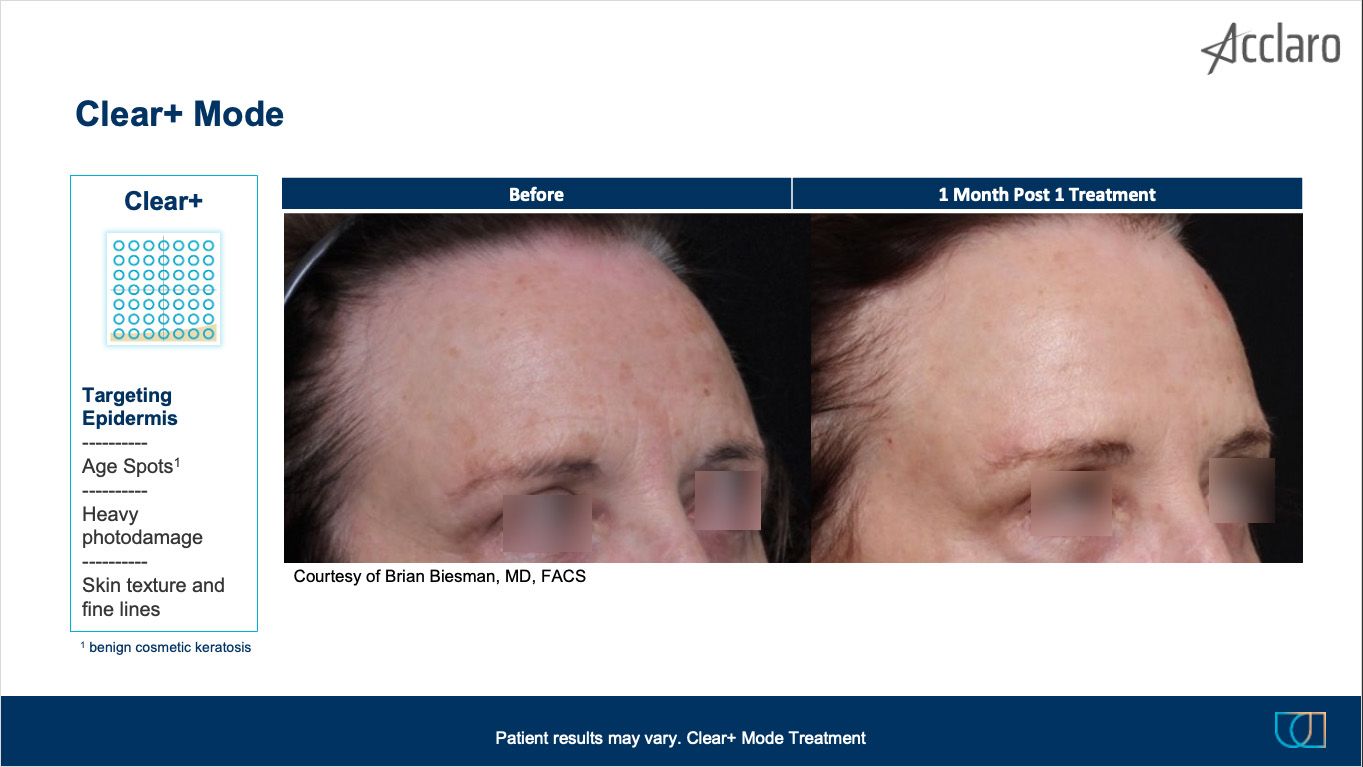 UltraClear Laser Performed by Brian Biesman