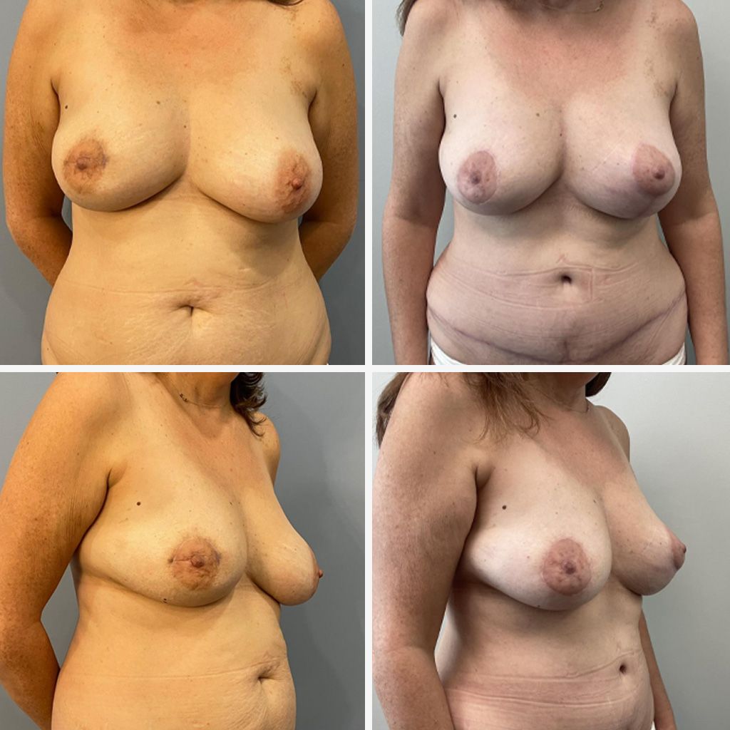 Breast Reconstruction Performed by Dr. Bonett