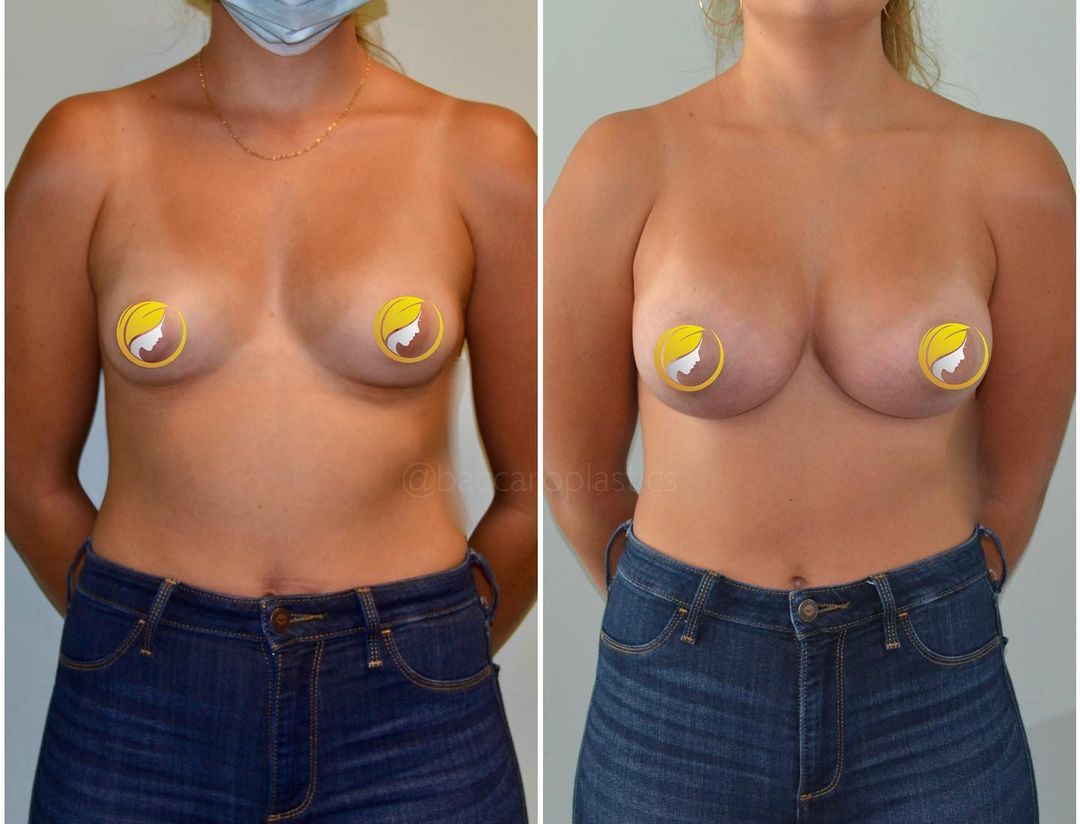Hybrid Breast Augmentation by Dr. Baccaro