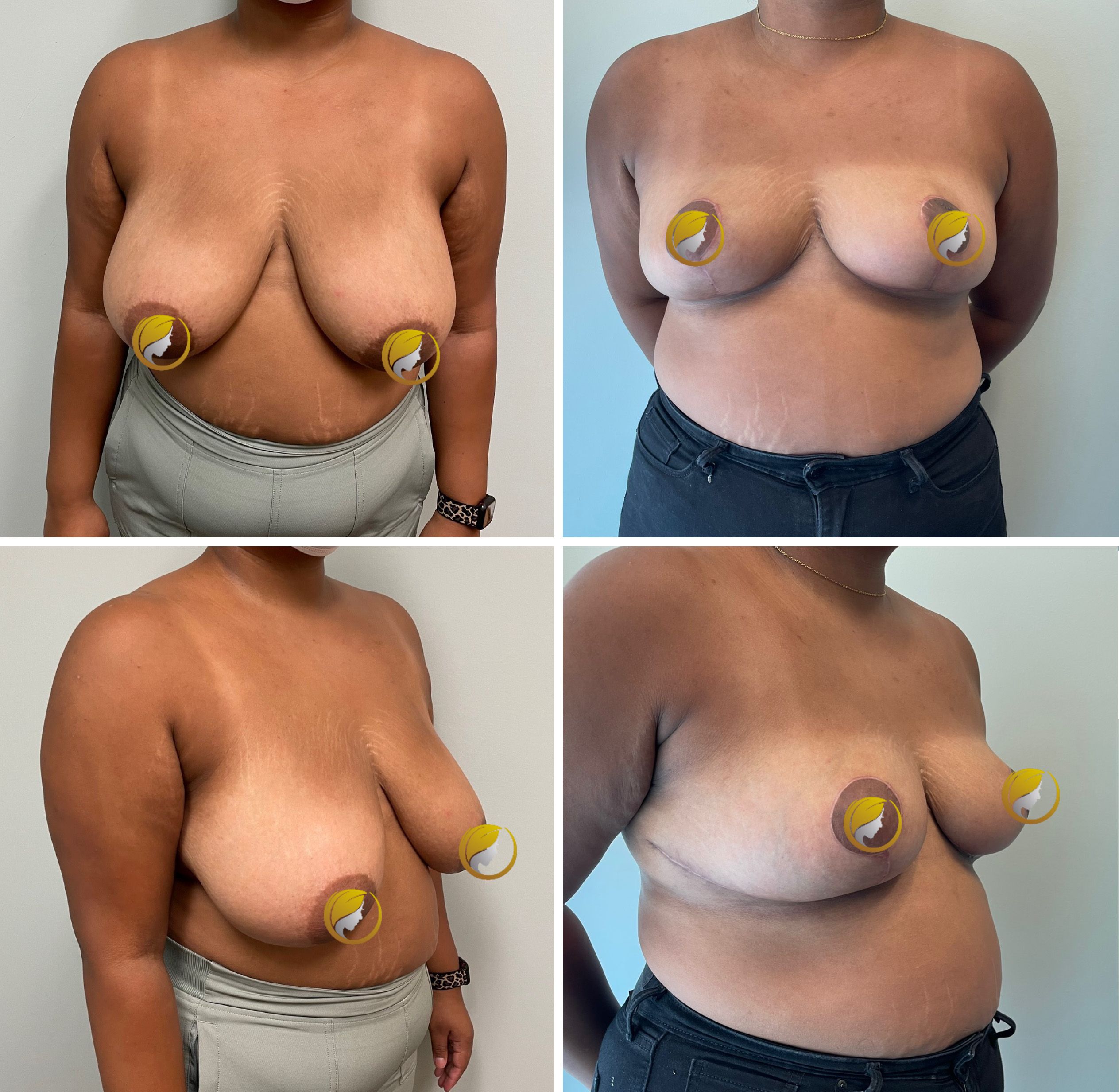 Surgery Performed by Dr. Andrew Bonett