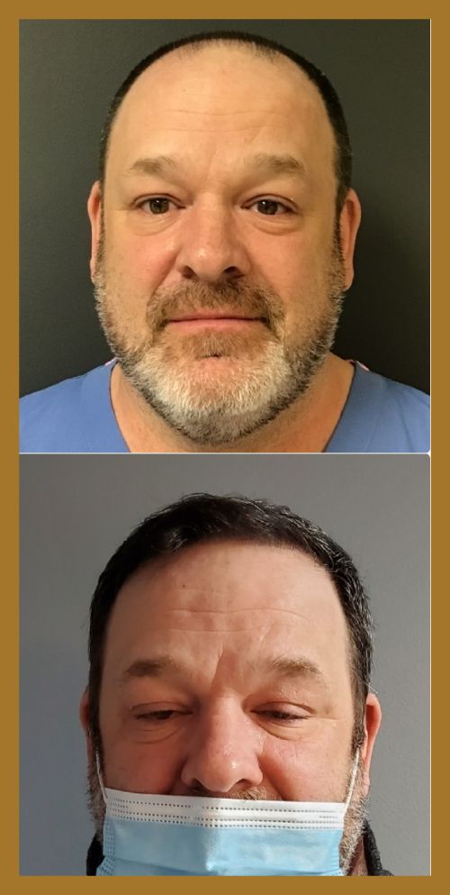 hair restoration before and after image.