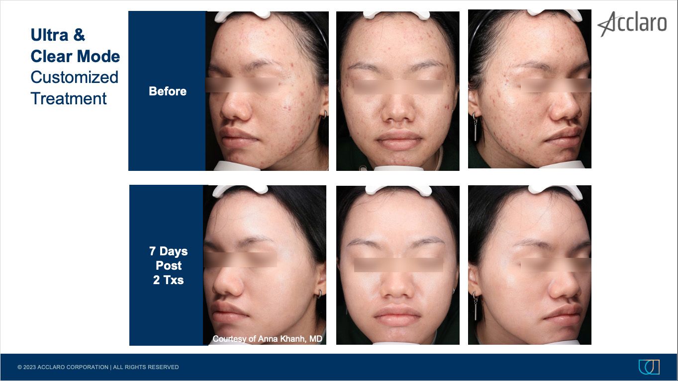 UltraClear Laser Performed by Anna Khanh