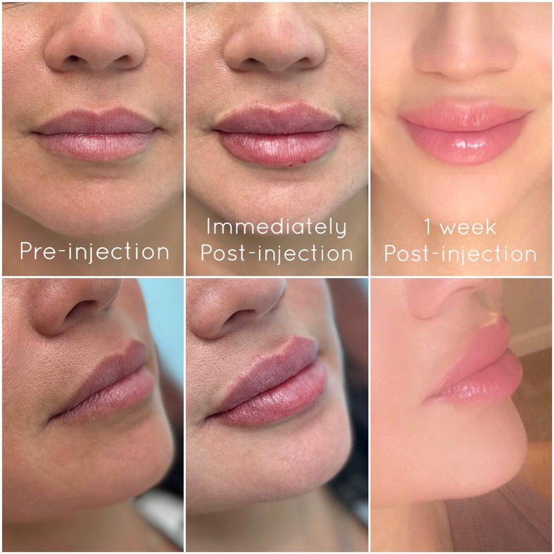 Lip  Augmentation by Dr. Baccaro