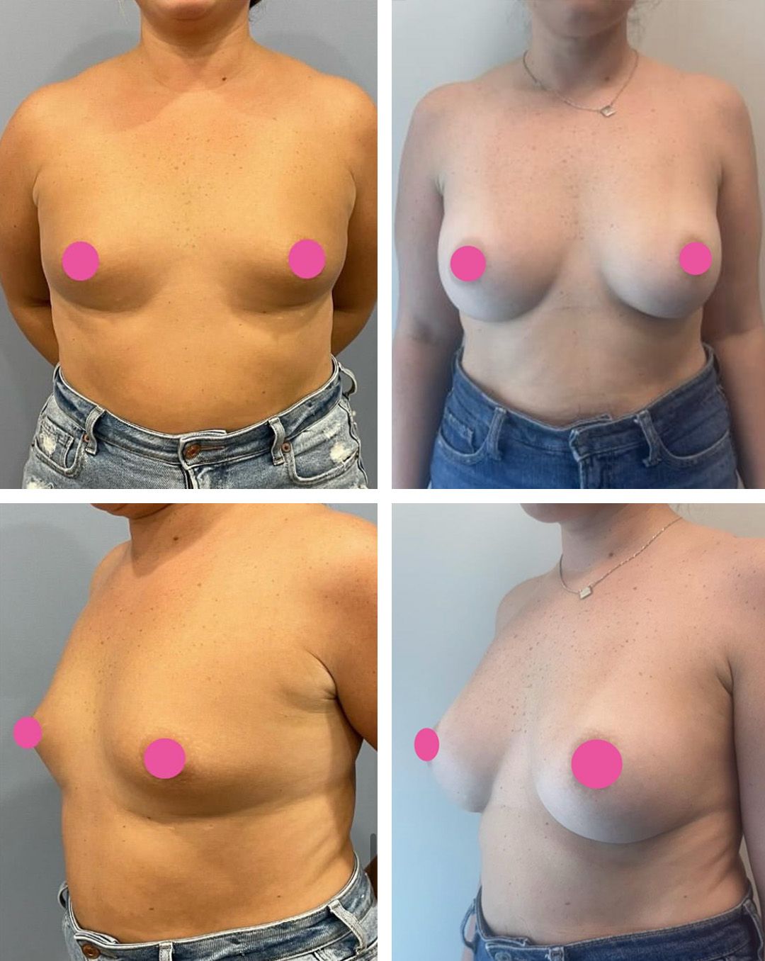 Breast Augmentation By Dr. Bonett