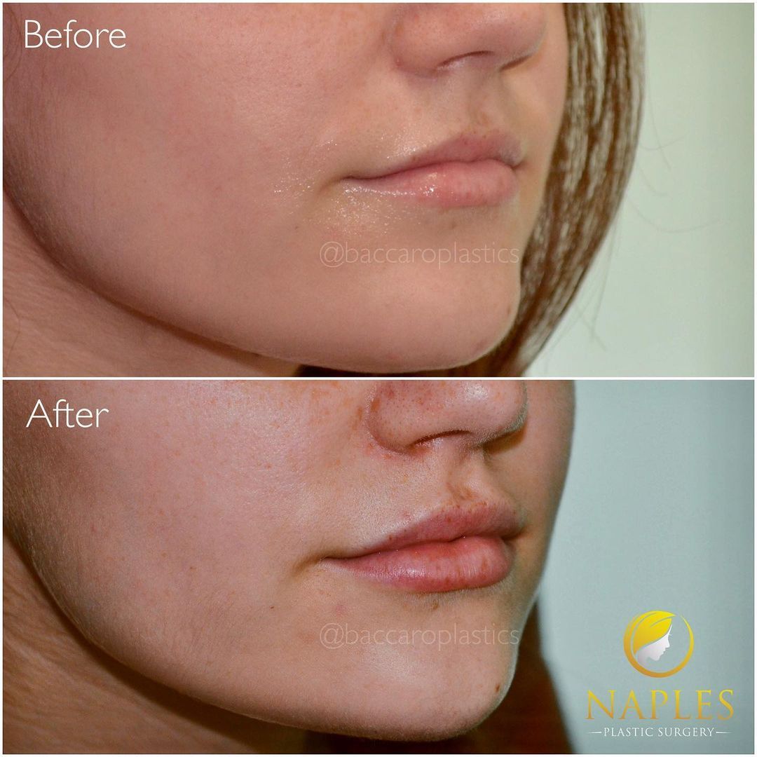Lip Augmentation by Dr. Baccaro