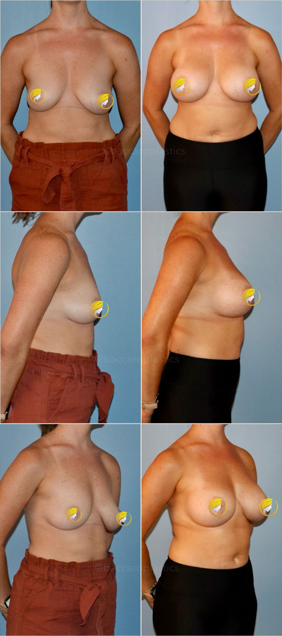 Hybrid Breast Augmentation Performed by Dr. Baccaro