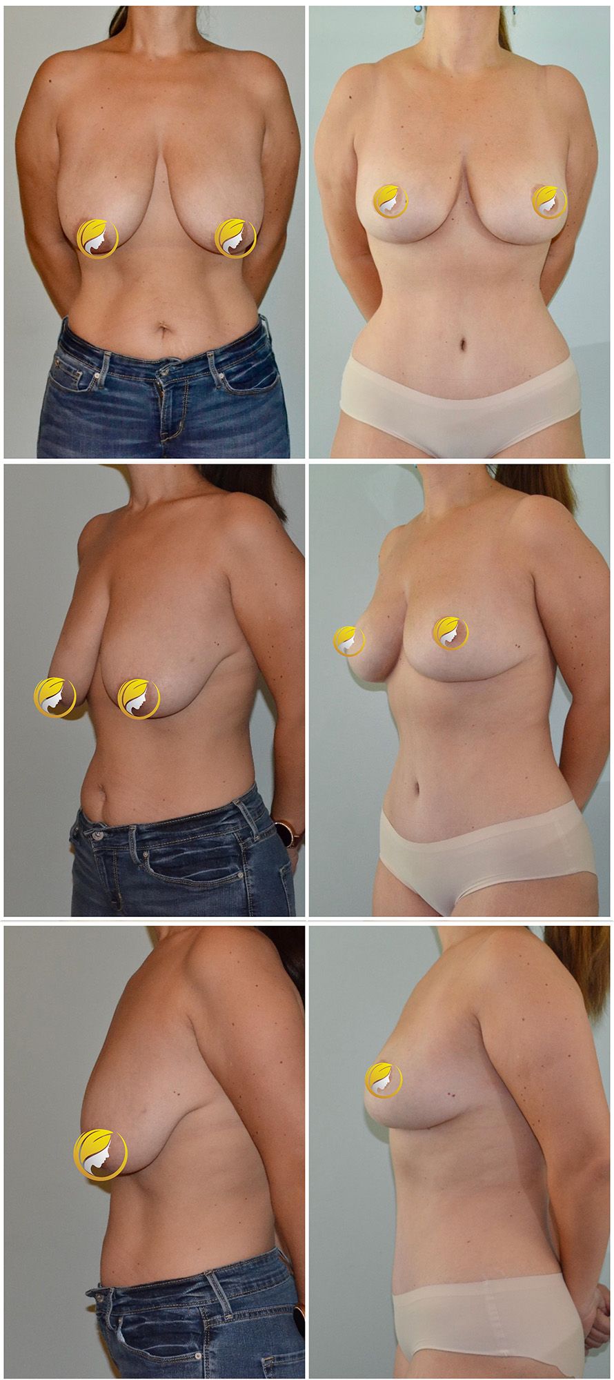 Mommy Makeover Performed by Dr. Baccaro