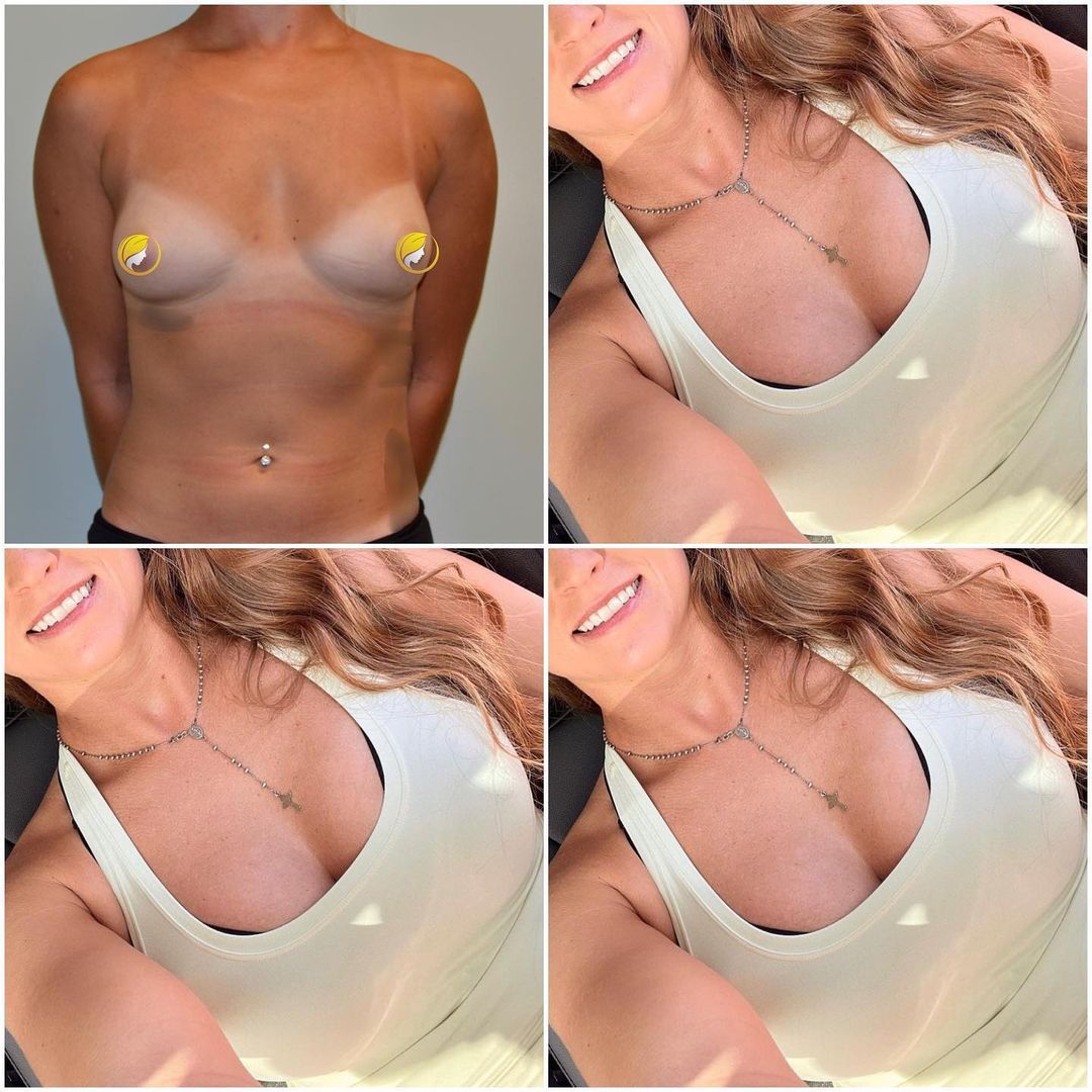 Hybrid Breast Augmentation by Dr. Baccaro
