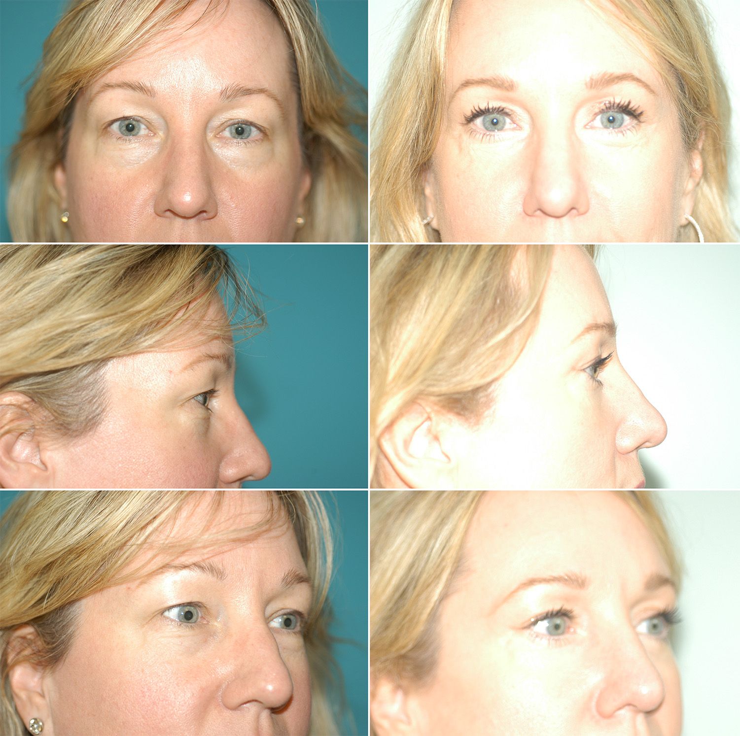 Blepharoplasty by Dr. Gardner
