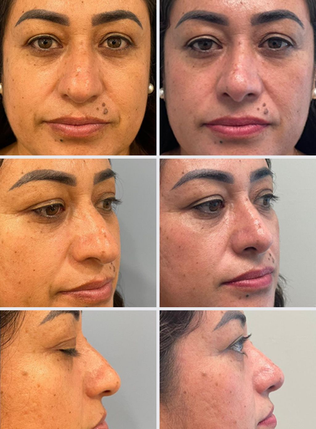 Rhinoplasty Performed by Dr. Bonett