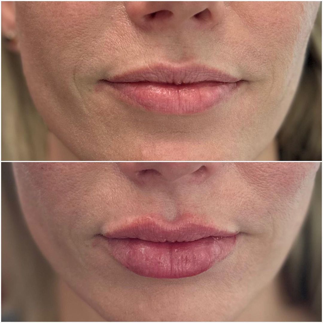 Lip Augmentation by Dr. Baccaro
