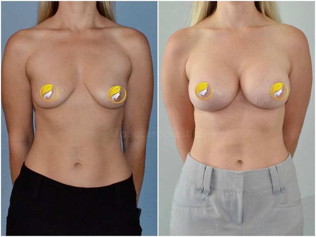 Hybrid Breast Augmentation by Dr. Baccaro