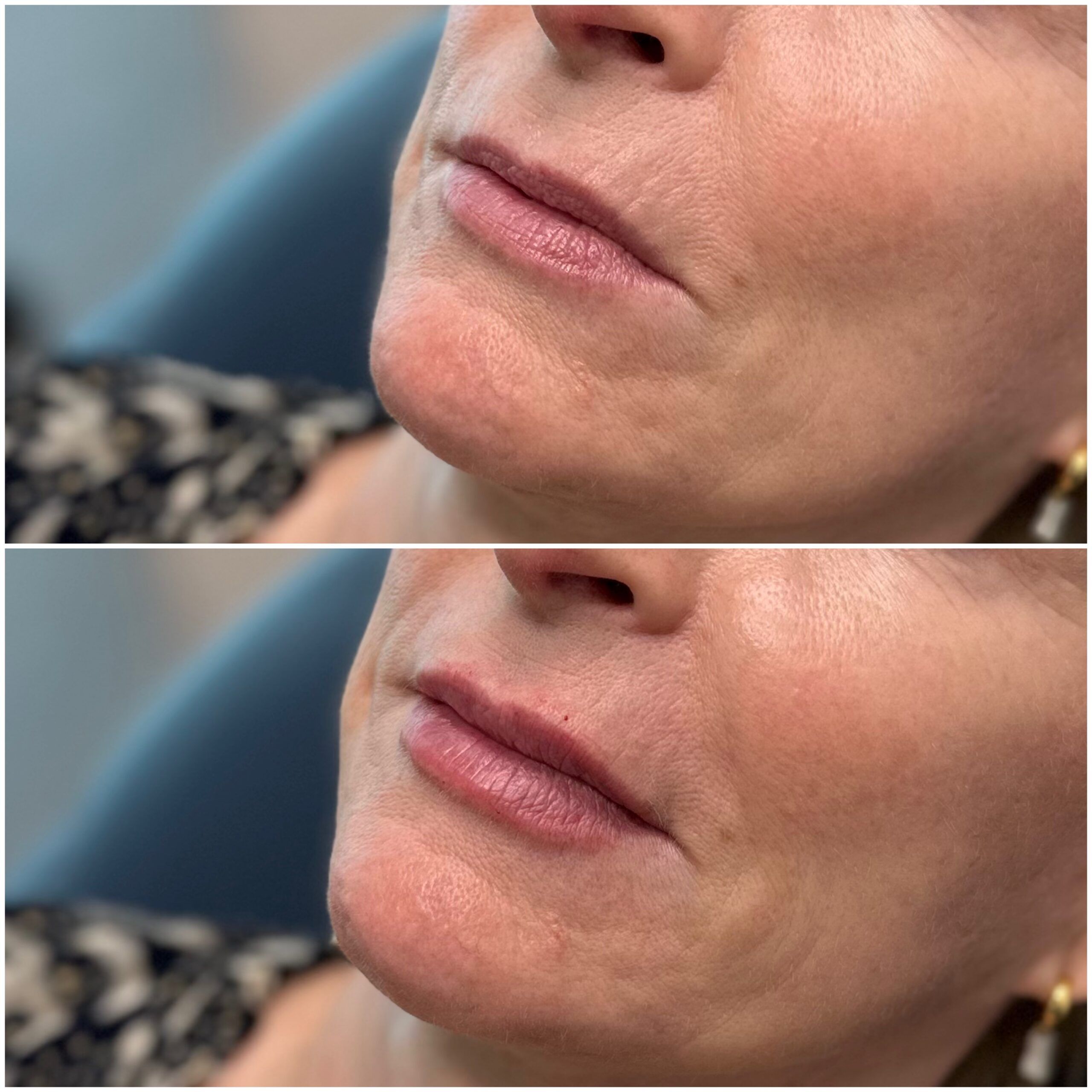 Lip Filler by Dr. Baccaro