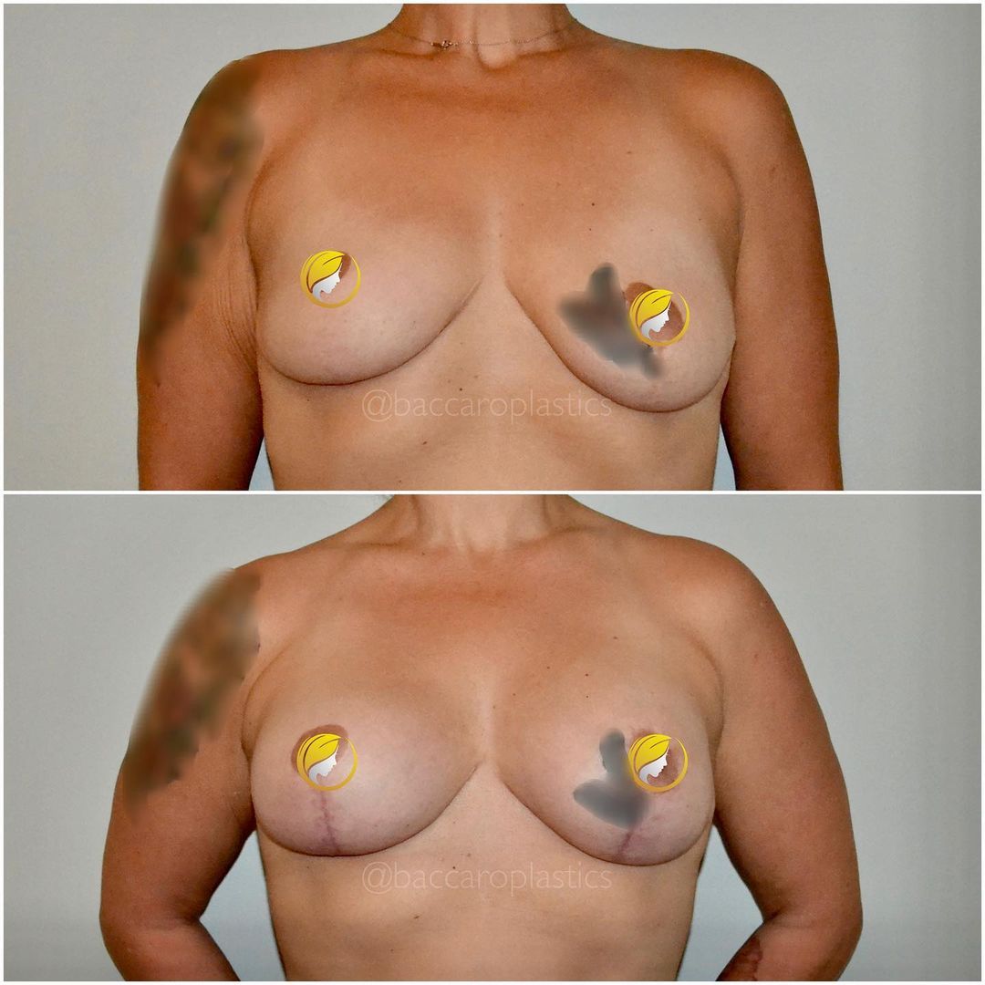 Hybrid Breast Augmentation and Lift by Dr. Baccaro