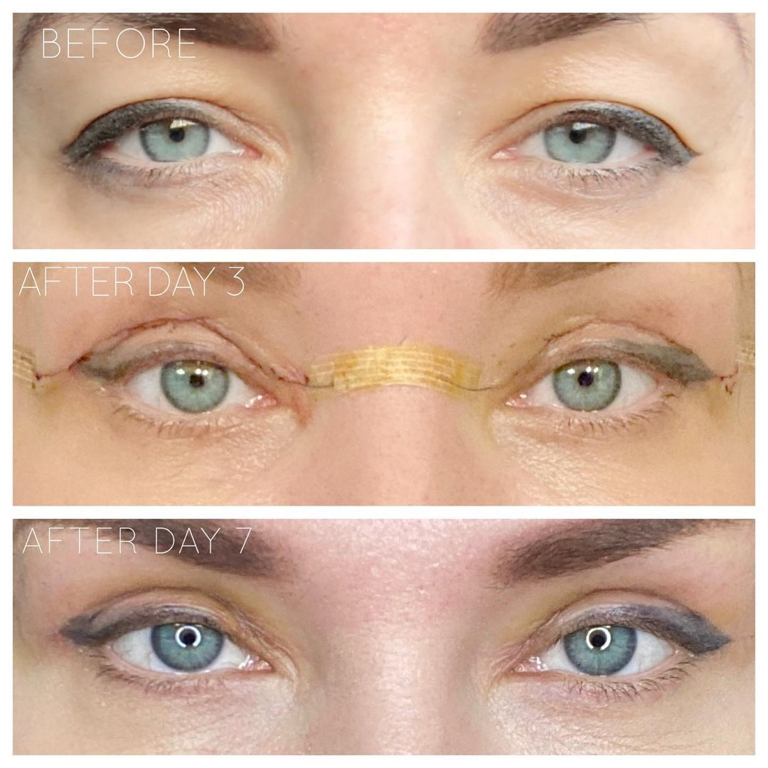Upper Eyelid Blepharoplasty by Dr. Baccaro