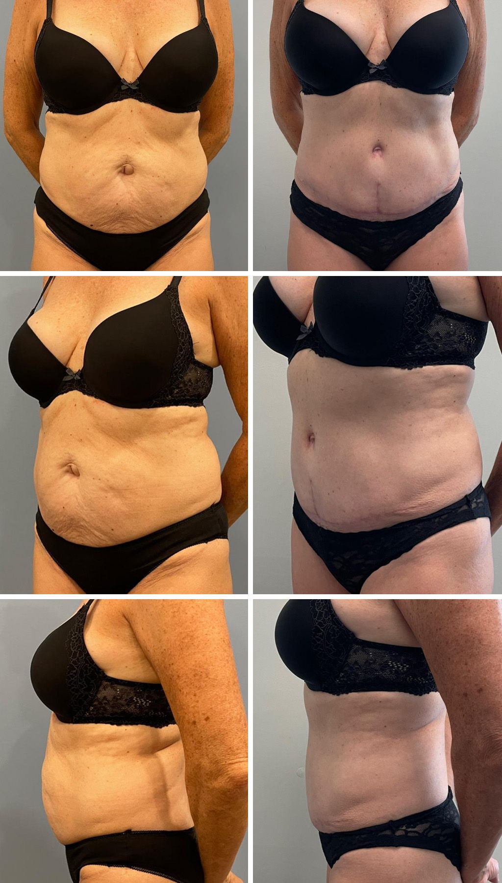 Tummy Tuck Performed by Dr. Bonett