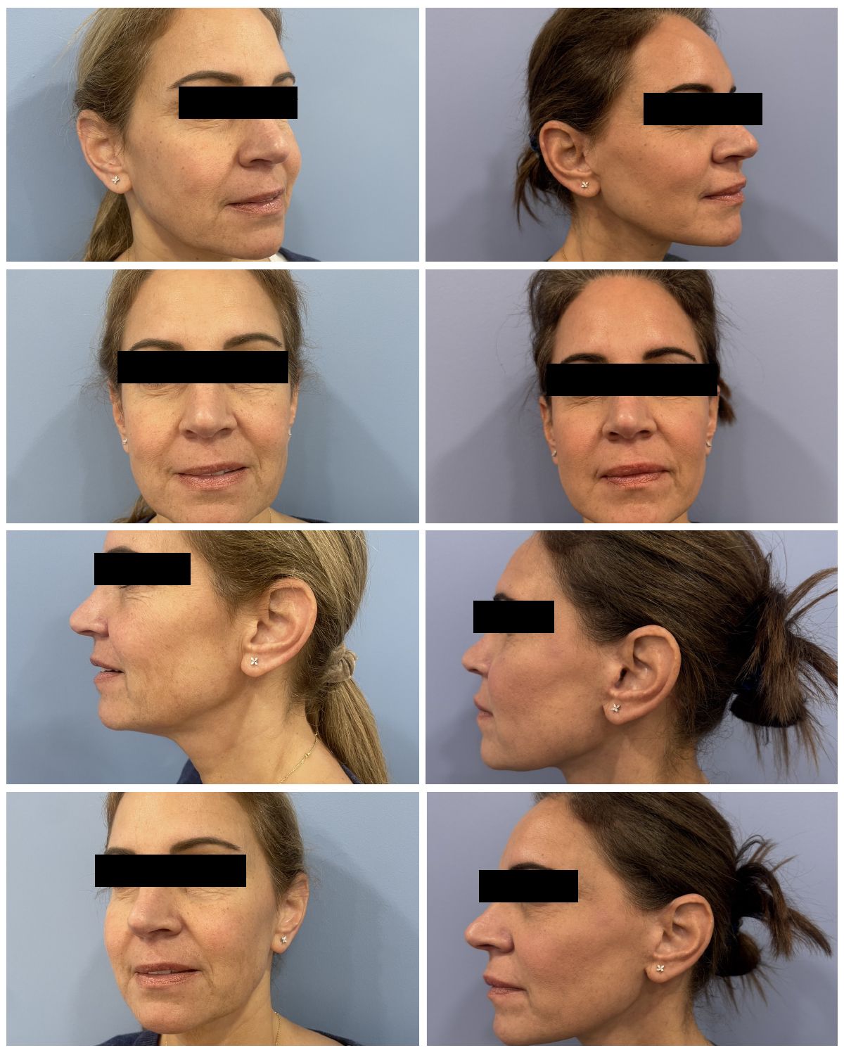 Dr. Walsh – Neck Lift Patient