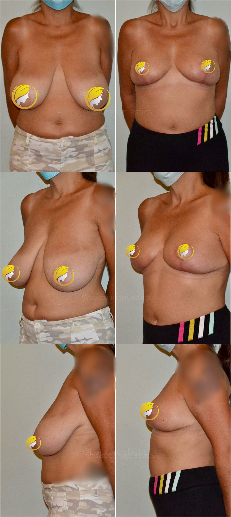 Breast Reduction Performed by Dr. Baccaro