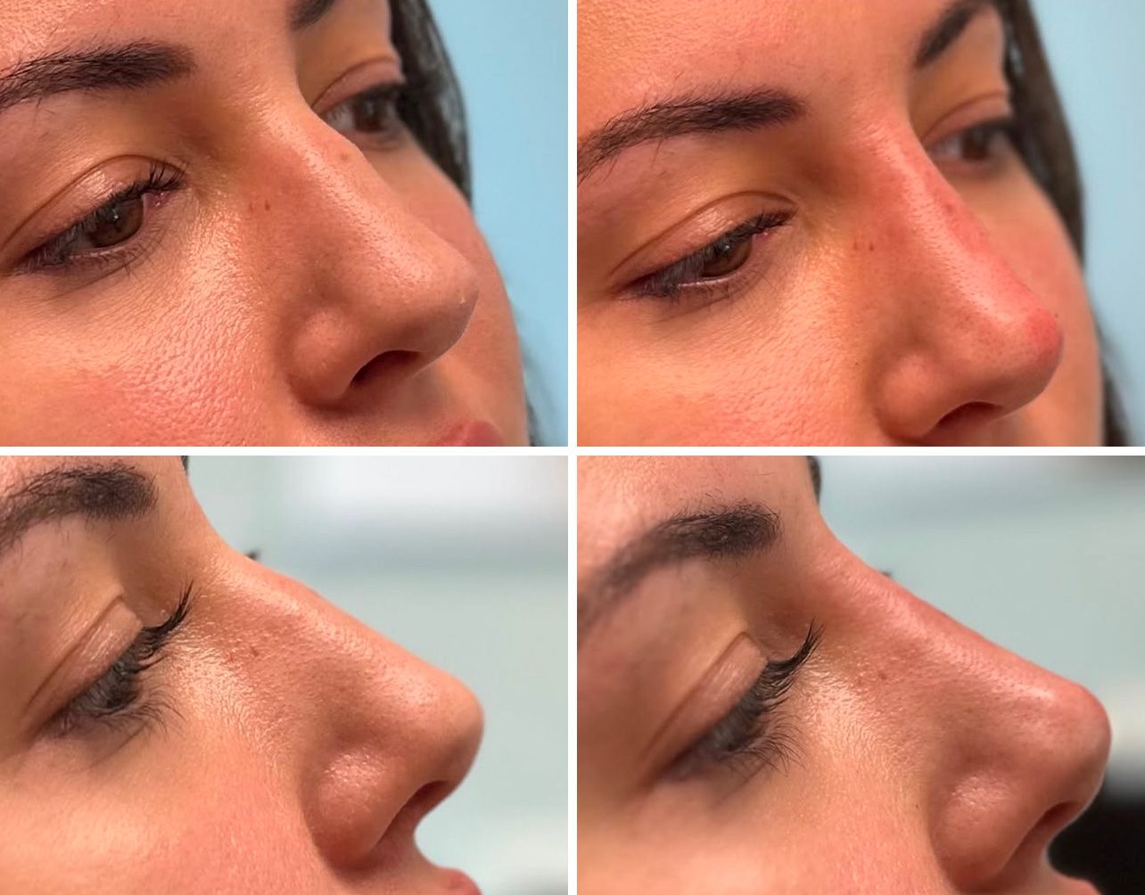 Liquid Rhinoplasty by Dr. Baccaro