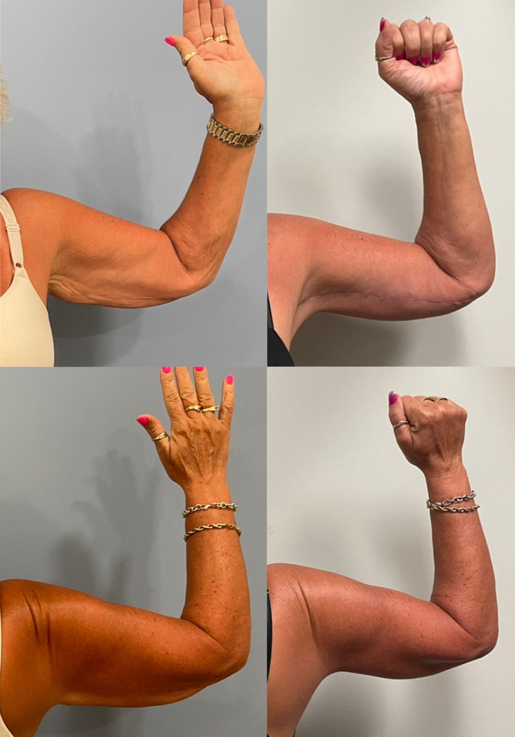 bonett arm lift