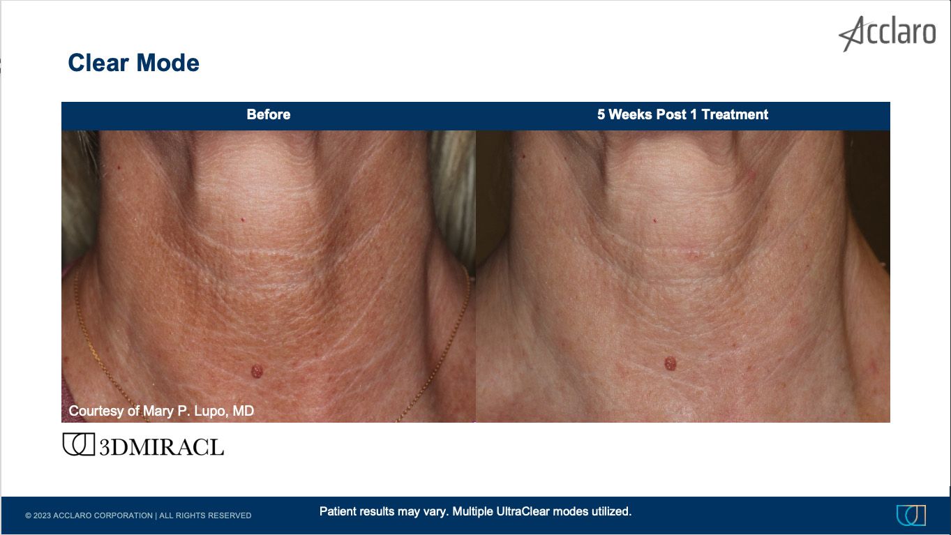 UltraClear Laser Performed by Mary Lupo